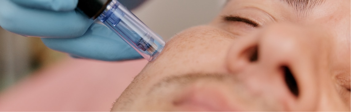 Stock photograph of a model: gloved hand pressing a small blue microneedling pen against a man's cheek.