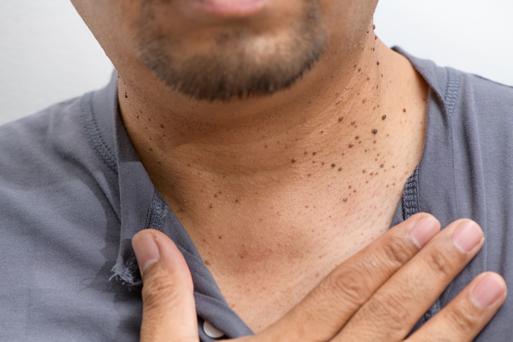 Stock photograph of a model: a man's neck and chest with several dark spots on the skin, as he touches his collarbone