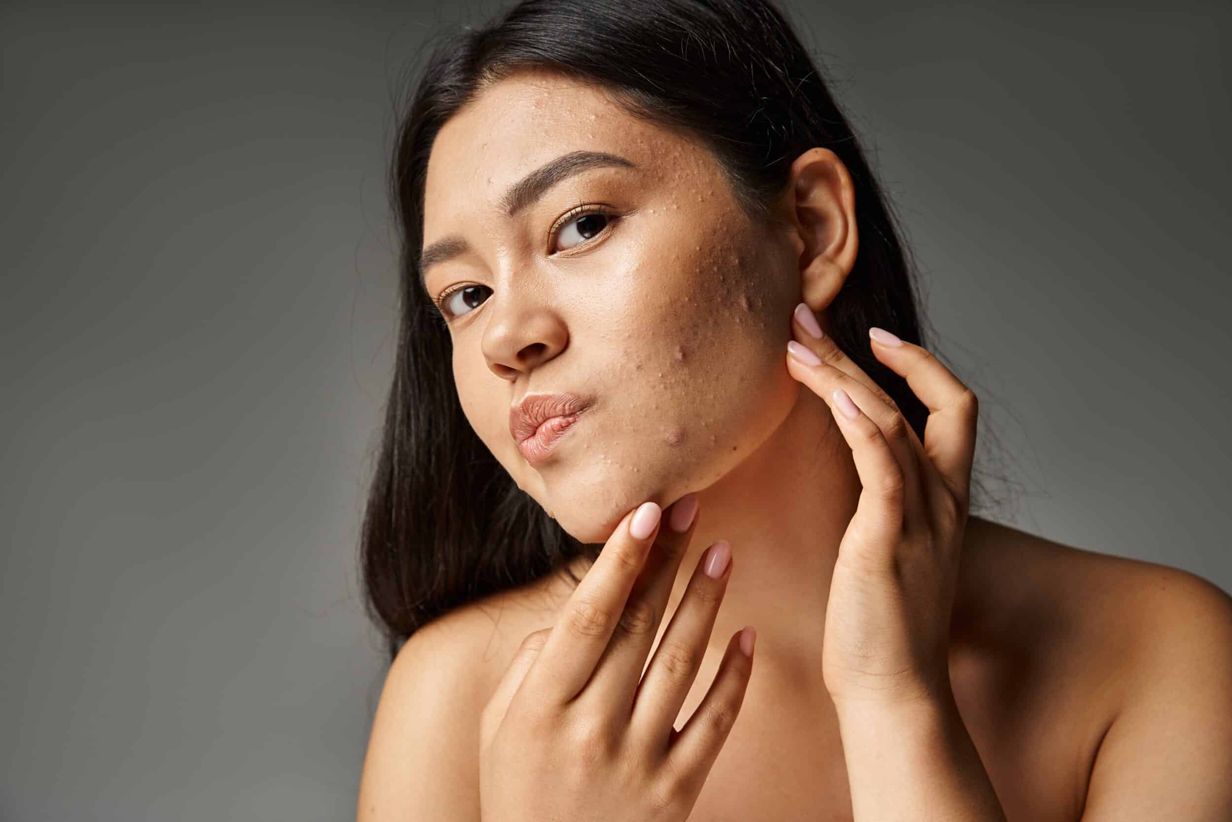 Stock photograph of a model: a woman with bare shoulders and dark hair touches her neck, with acne marks on her cheek