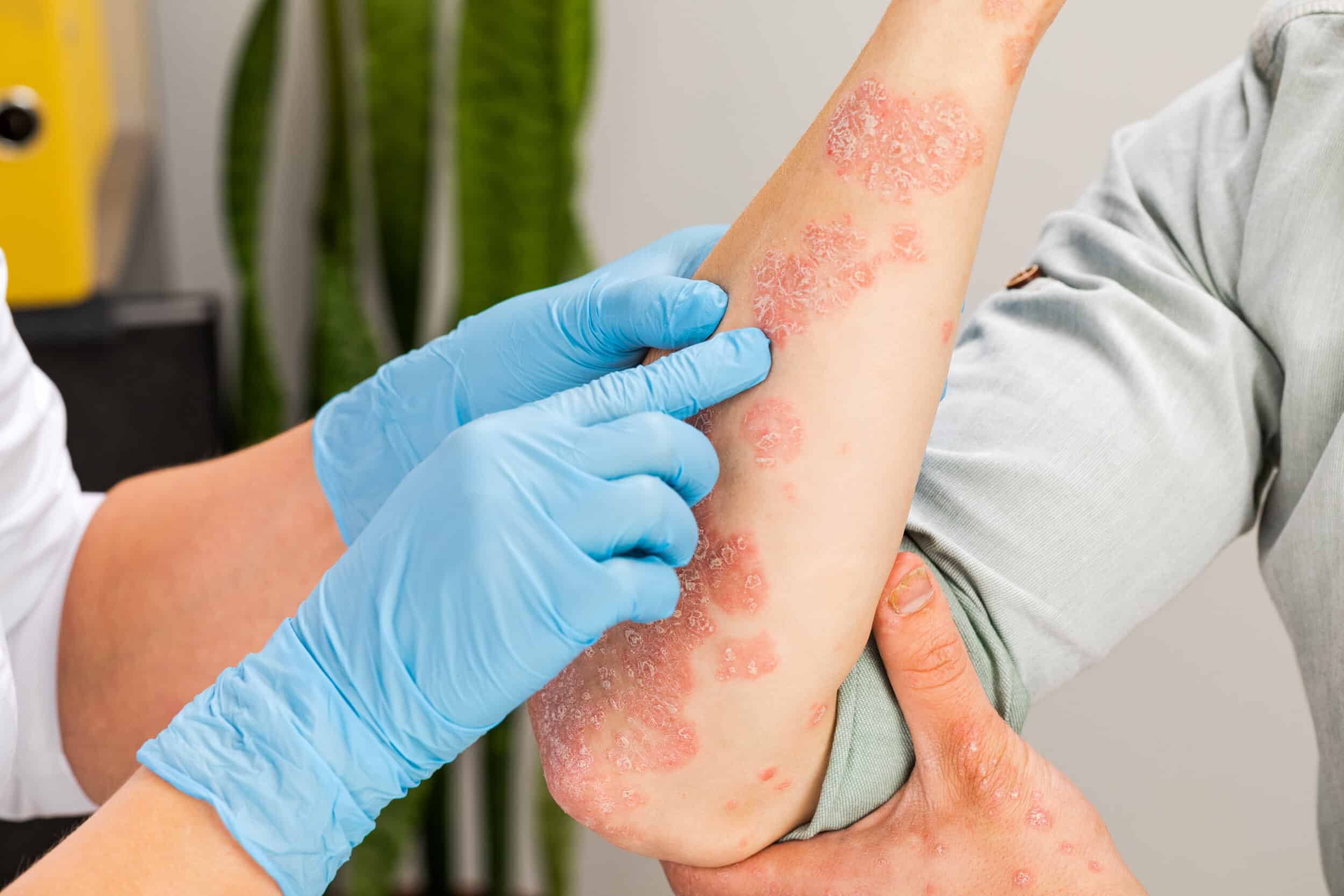 Stock photograph of models: gloved hands examine red, scaly psoriasis patches on a forearm