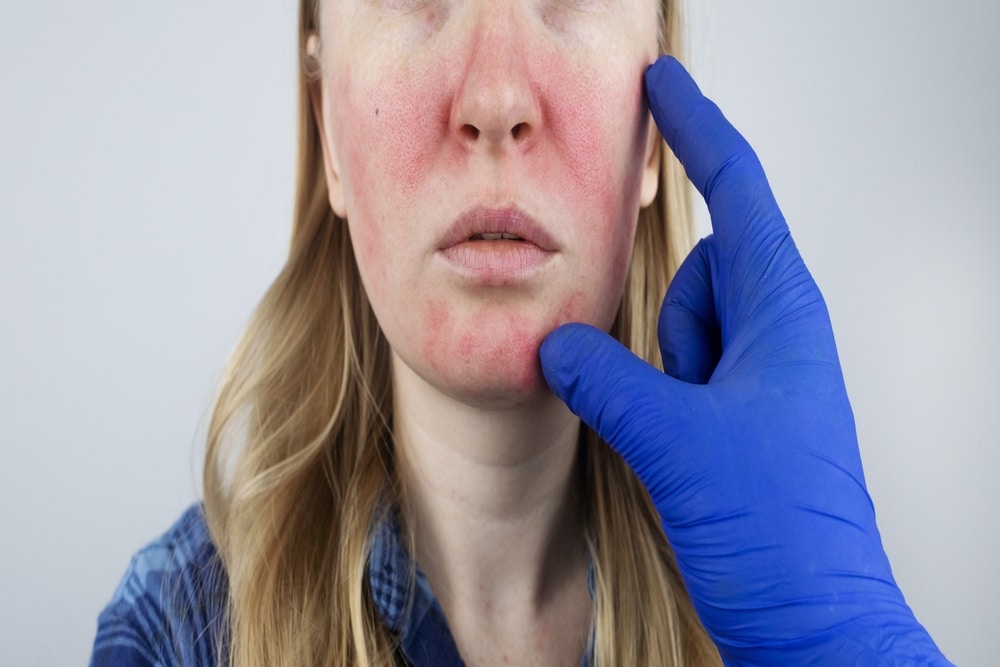 Stock photograph of a model: a gloved hand points to redness across a woman's cheeks and nose