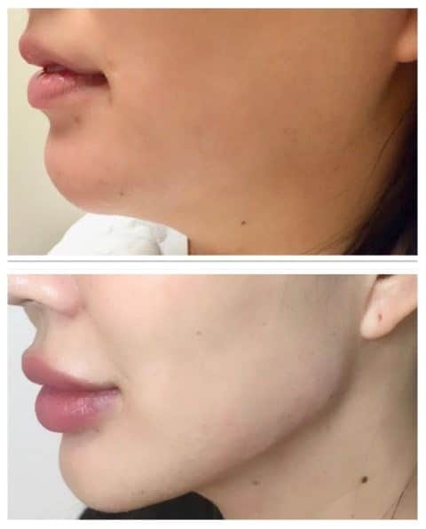 Fillers Jawline Lip Before and after Berkeley CA