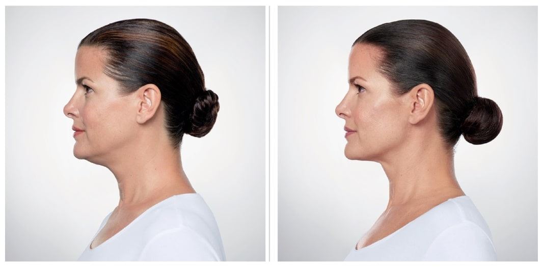 Kybella before and after Berkeley CA