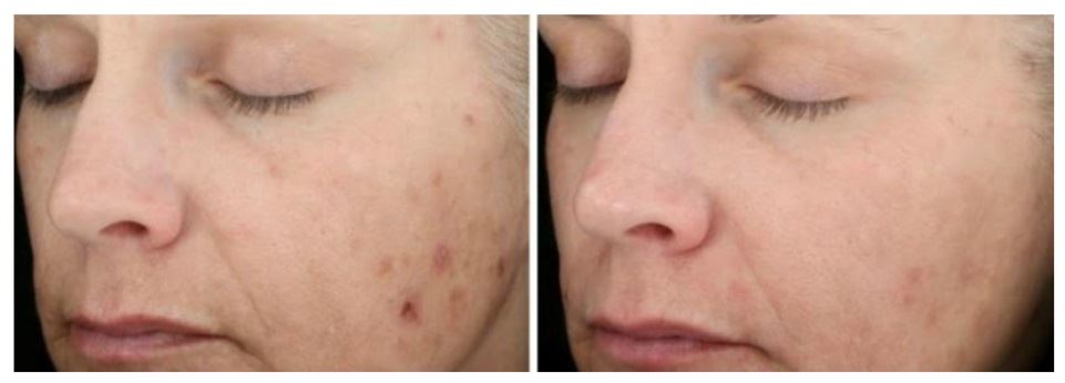 Chemical Peel before and after Berkeley CA
