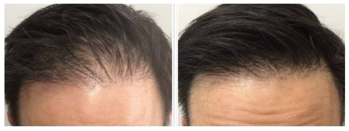 Hair Restoration PRP before and after Berkeley CA