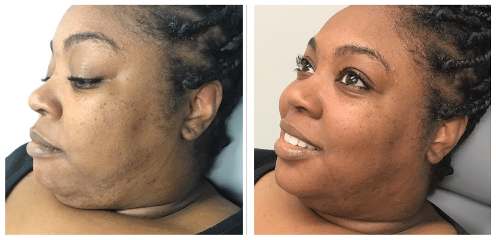 Dermaplaning before and after Berkeley CA