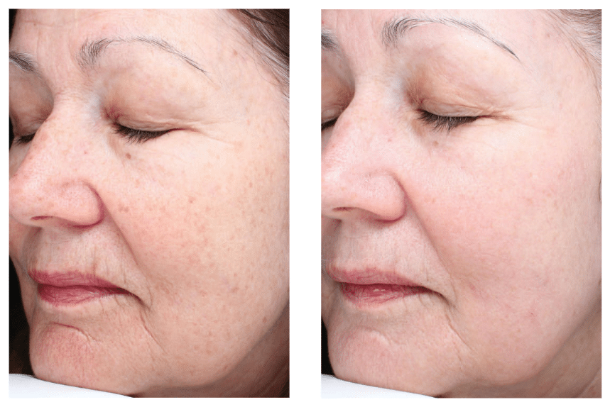 Fractional Laser Patient Before and Afters