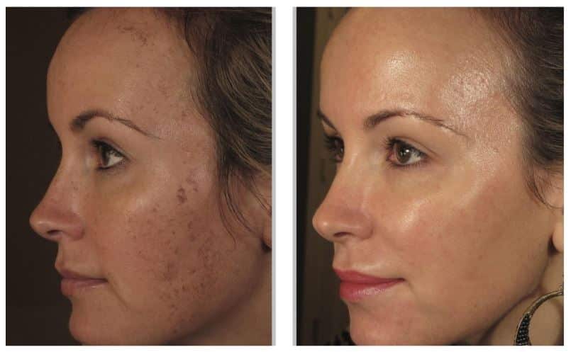 before and after pictures of a woman with acne who received laser skin treatments