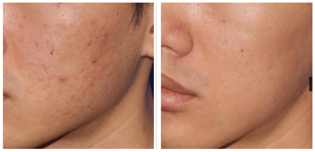 Microneedling Before and after Berkeley CA