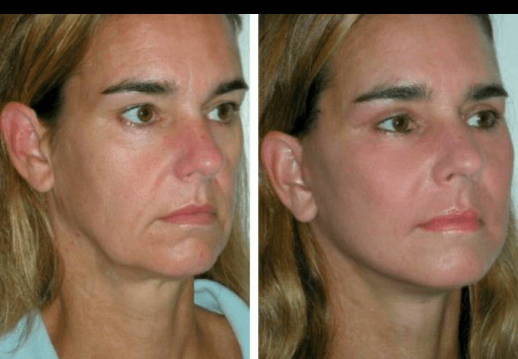 Nova Threads LipSculpting before and after Berkeley CA