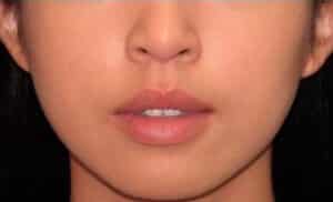 After Image: Botox – Xeomin – Dysport – Jawline