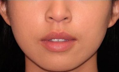 After Image: Botox – Xeomin – Dysport – Jawline - front
