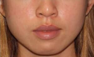 Before Image: Botox – Xeomin – Dysport – Jawline