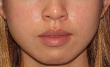 Before Image: Botox – Xeomin – Dysport – Jawline - front