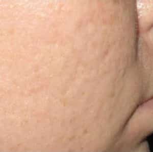 After Image: Microneedling
