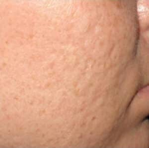 Before Image: Microneedling