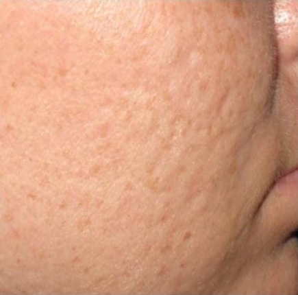 Before Image: Microneedling - right-side