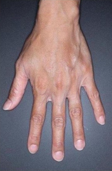 After Image: Fillers - front