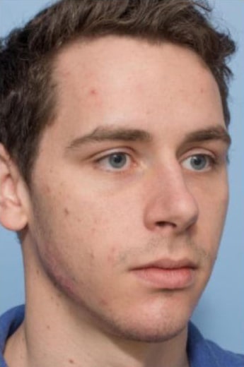 After Image: Fillers - right-front-oblique