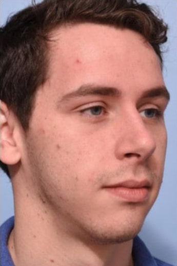 Before Image: Fillers - right-front-oblique