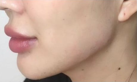 After Image: Fillers - left-side
