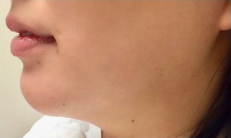 Before Image: Fillers - left-side