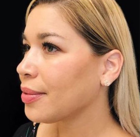 After Image: Fillers - left-front-oblique