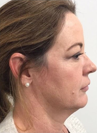 Before Image: Fillers - right-side
