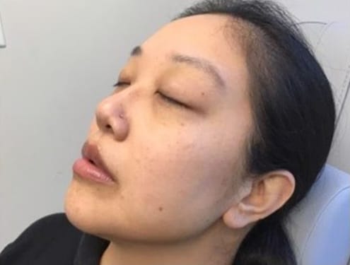 After Image: Fillers - left-front-oblique