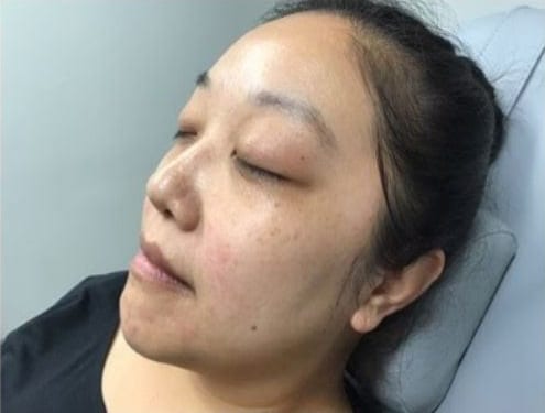 Before Image: Fillers - left-front-oblique