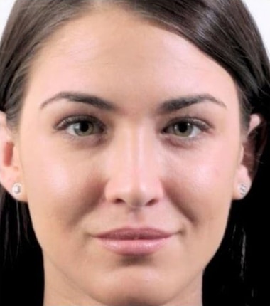 After Image: Fillers - front
