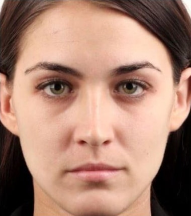 Before Image: Fillers - front