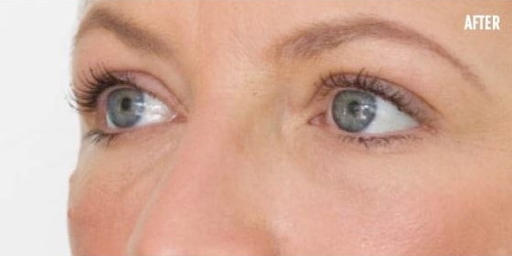 After Image: Fillers - left-front-oblique