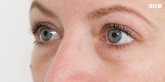 Before Image: Fillers - left-front-oblique