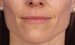 After Image: Botox/Xeomin/Dysport