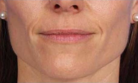 After Image: Botox/Xeomin/Dysport - front