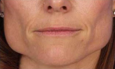 Before Image: Botox/Xeomin/Dysport - front