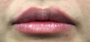 After Image: Fillers