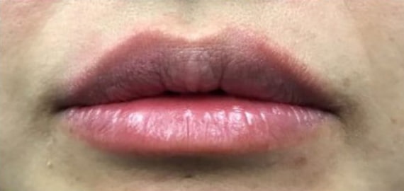 After Image: Fillers - front