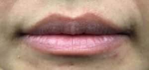 Before Image: Fillers