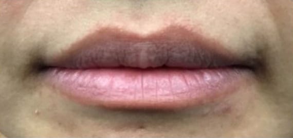Before Image: Fillers - front