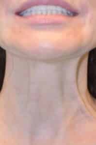 After Image: Botox/Xeomin/Dysport