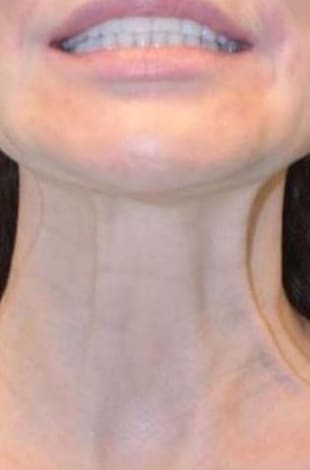 After Image: Botox/Xeomin/Dysport - front