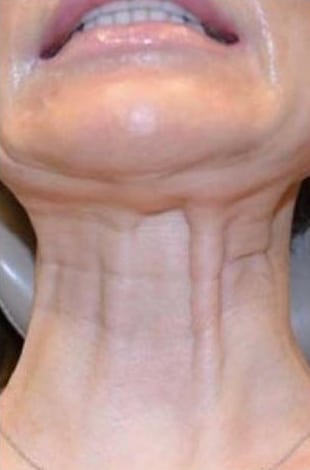 Before Image: Botox/Xeomin/Dysport - front