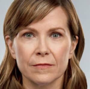 Before Image: Fillers