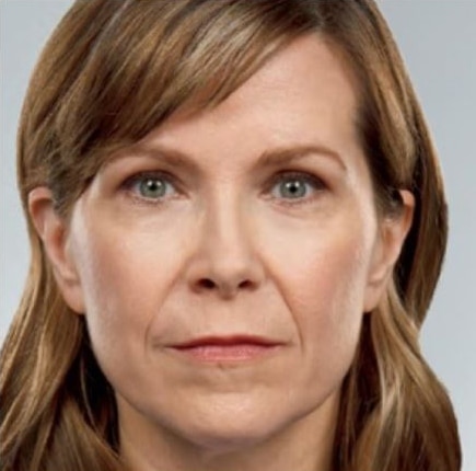 Before Image: Fillers - front