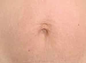 After Image: Microneedling