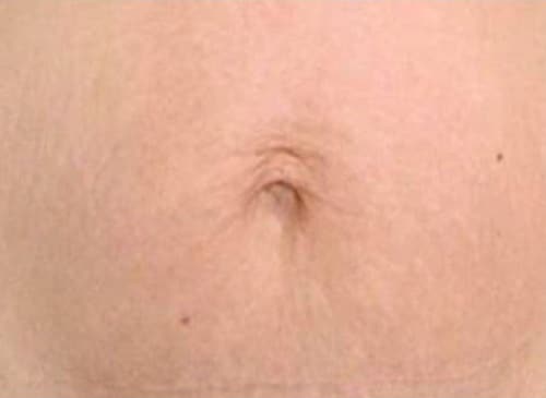 After Image: Microneedling - front
