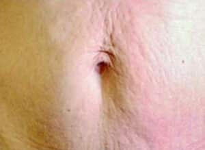 Before Image: Microneedling