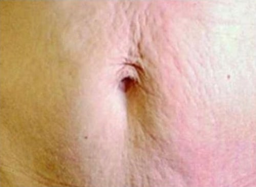 Before Image: Microneedling - front